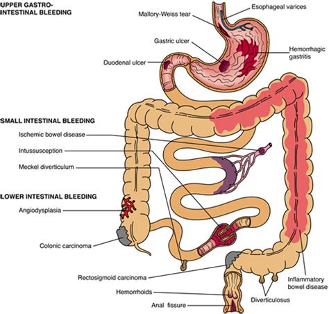 GI Bleeding | Varicose veins | Vascular surgeon | Stroke | DVT | Leg ...