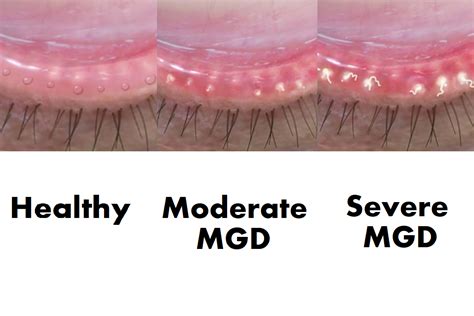 Meibomian Gland Dysfunction | Regional Eye Center