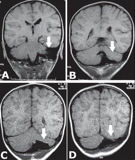 Researchers have discovered the mechanism of brain syndrome called ...