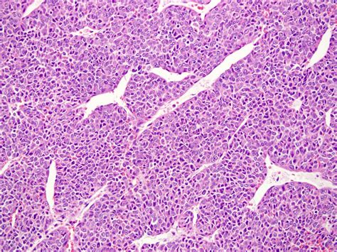 Malignant Tumor Histology