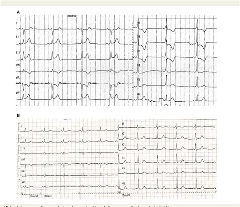 Figure 1 from Inferior wall STEMI exposing a concealed problem: what's ...