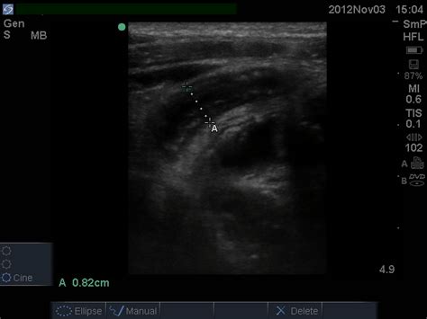 Clinical Case 073: Sorting out the RIF raff - Broome Docs