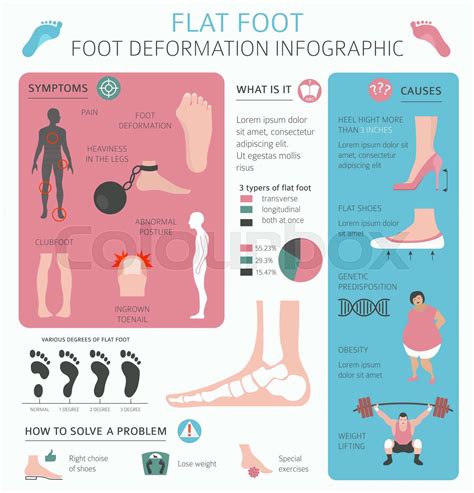 Foot deformation as medical desease infographic. Causes of Flat foot ...