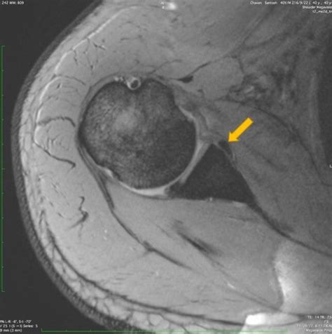 [Figure, axial section of shoulder MRI showing Bankart lesion ...