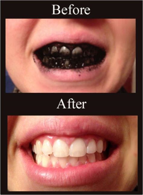 10 Easy And Effective Recipes For Whitening Your Teeth At Home