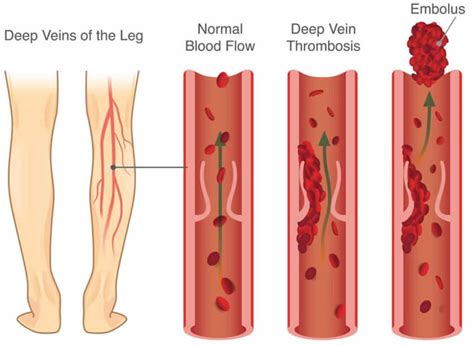 Blood clot causes, symptoms, diagnosis, prevention, prognosis & treatment