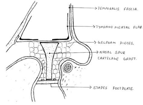 Showing long columella ossiculoplasty (myringoplatinopexy) with ...