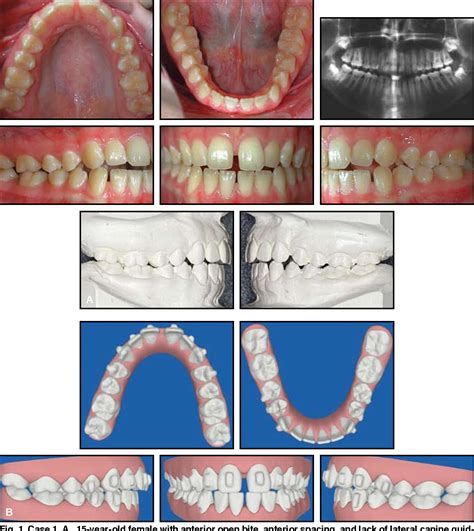 Figure 1 from Treatment of anterior open bite with the Invisalign ...