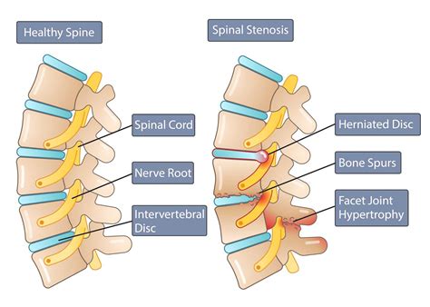 Vertebral Disc Anatomy