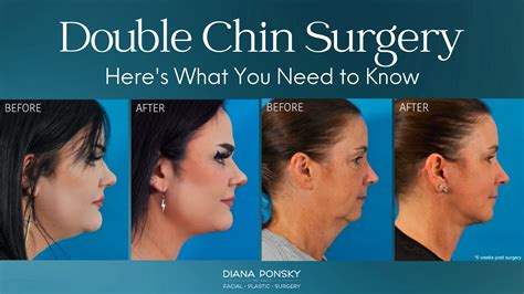 Double Chin Surgery: Here's What You Need to Know