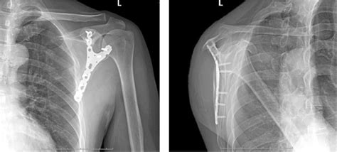 Postoperative scapular X-ray radiographies of the implanted Y-type ...