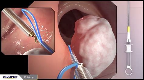 Colonoscopy with polypectomy procedure overview using Olympus devices ...