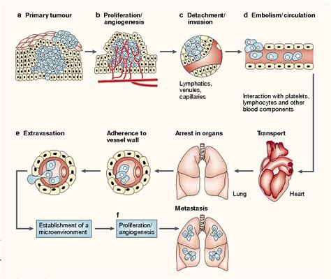 Stages Of Tumor Development And Mechanism Of Metastasis Download