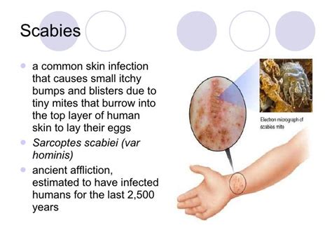 What Causes Scabies Rash