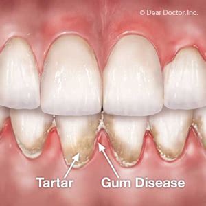 Prompt Treatment for Gum Disease Could Ultimately Save Your Teeth