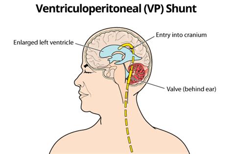 Walter's Hydrocephalus Education blog: Recovery after VP shunt implant ...