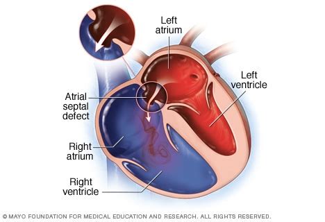 Atrial septal defect (ASD) - Symptoms and causes - Mayo Clinic