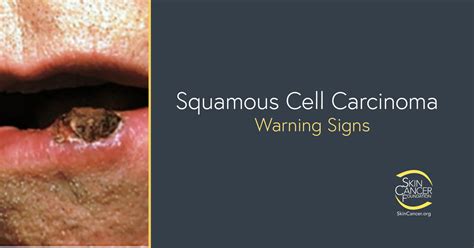 Squamous Cell Cancer Symptoms