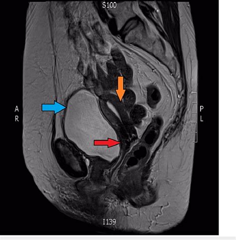 Sagittal view from MRI scan Blue arrow: Bladder; Orange arrow: Fundus ...