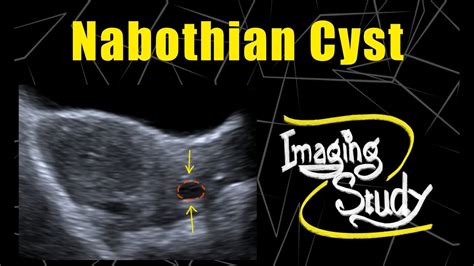 Nabothian Cyst In Cervix Ultrasound