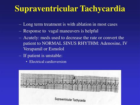 PPT - Supraventricular Tachycardia PowerPoint Presentation, free ...