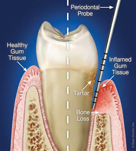 Periodontal Therapy | Family and Children’s Dentistry | Atlanta Georgia