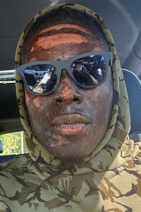 Cleveland Browns' David Njoku Shares First Pictures of Facial Burns