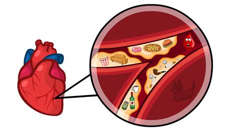 Arteriosclerosis / Coronary Artery Disease Drawing by Yoshiko-Animation ...