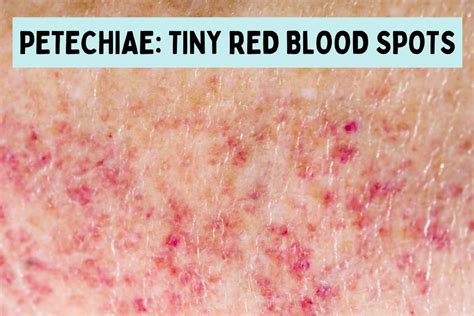 Petechiae: What Causes These Tiny Red Blood Spots on Skin?