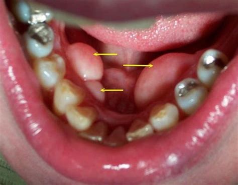 www.BestOgdenDentist.com Blog: Those bumps are called tori.