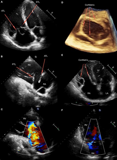 a, b Transthoracic echocardiography at admission-tricuspid valve ...