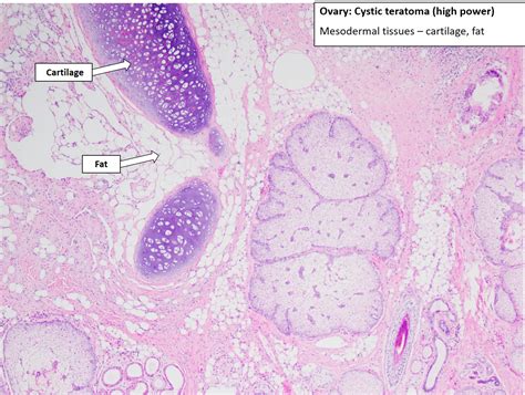 Ovary – Cystic Teratoma – NUS Pathweb :: NUS Pathweb