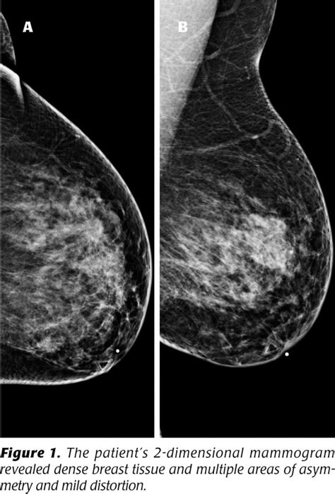 Tomosynthesis, Definitive image for improved breast cancer diagnosis