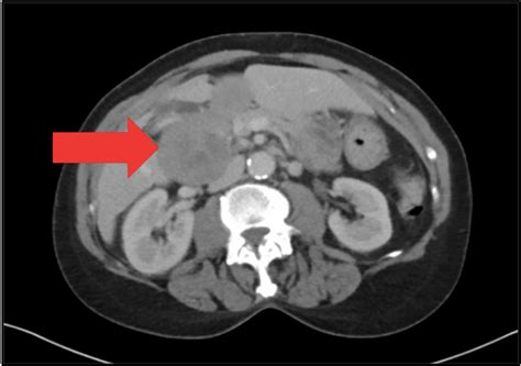 Cureus | Cancer Arising in a Duodenal Duplication Cyst: A Rare Genetic ...