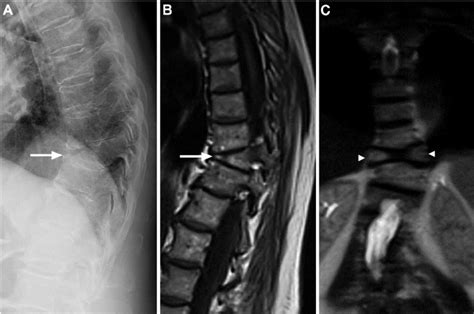 Lateral Thoracic Spine X Ray