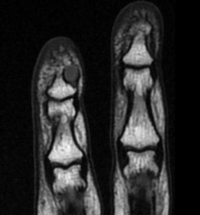 Glomus tumor - hand | Image | Radiopaedia.org