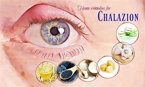 Home Eye Stye Treatment Chalazion Treatment Eyelid