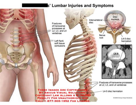 AMICUS Illustration of amicus,injury,lumbar,fracture,transverse,process ...