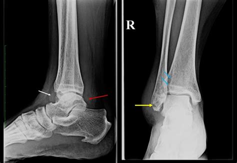 Weber A fibula fracture – Radiology Cases