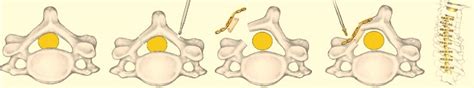 Cervical Laminoplasty - Procedure | Texas Spine and Neurosurgery Center ...