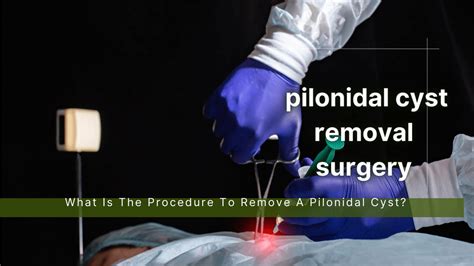 What Is The Procedure To Remove A Pilonidal Cyst?