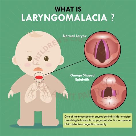 What is laryngomalacia? - Dr. Ankit Parakh