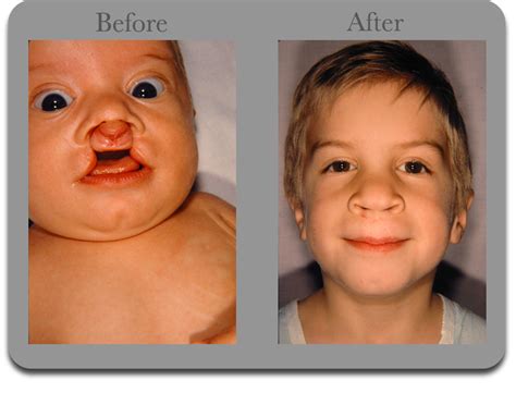 Plastic Surgery Can Correct Cleft Palate and Lips | Treatment for Cleft ...