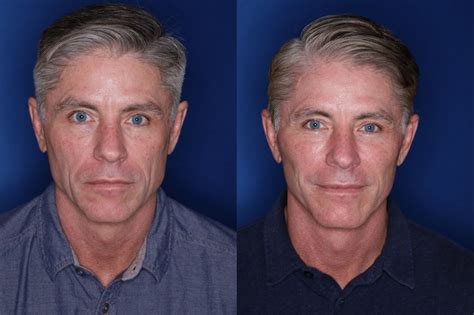 🥇 Atlanta Male Facelift Surgery | Buckhead Male Facelift Surgeon