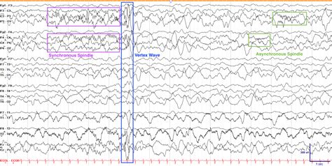 Normal Eeg Tracing