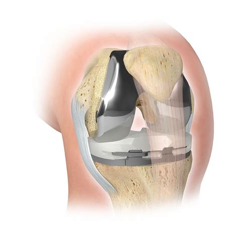 Zimmer Biomet - Knee Replacement