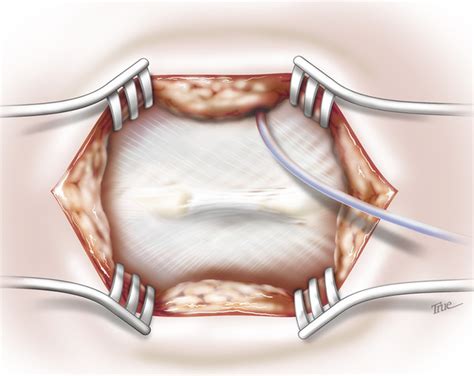 Lumboperitoneal Shunting | Neupsy Key