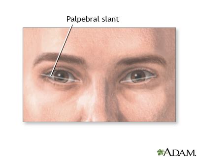 Palpebral slant - eye Information | Mount Sinai - New York