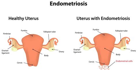 Endometriosis In Nigeria: Causes, Symptoms & Treatment | FabWoman