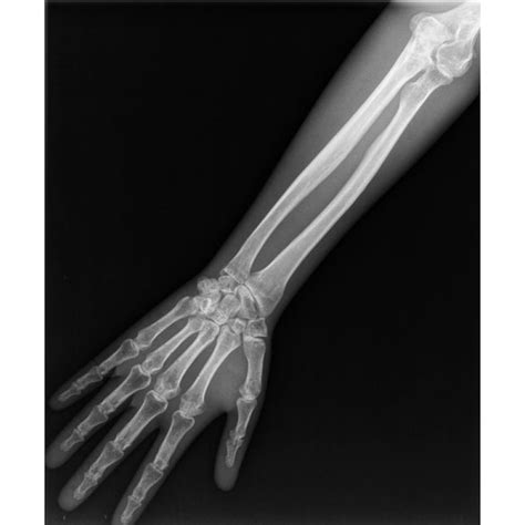 BROKEN ARM 1 | buyxraysonline